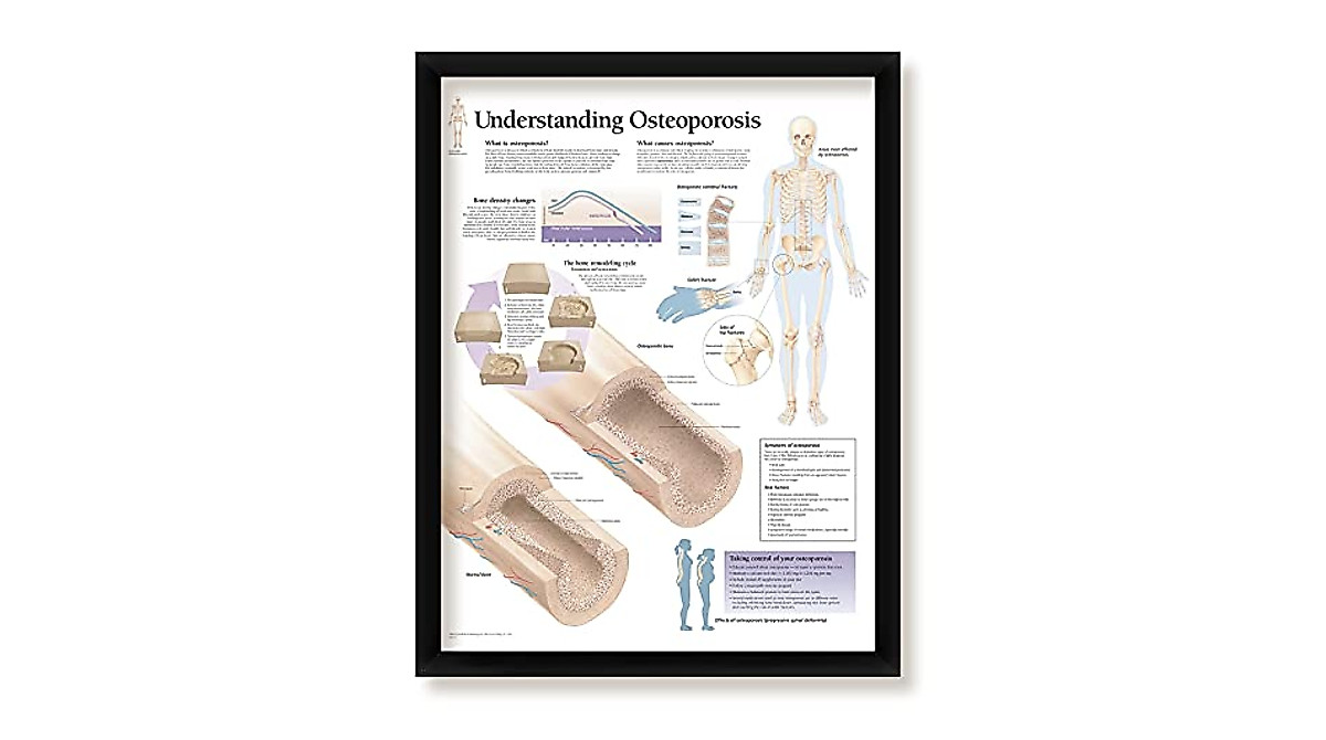 Framed Medical Posters Set: Osteoarthritis & More