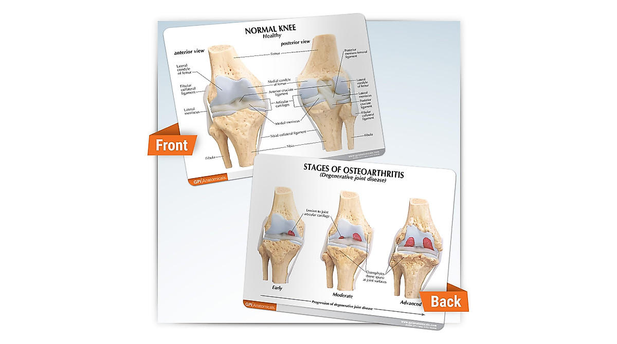 GPI Anatomicals Knee Joint Model Set - Osteoarthritis Anatomy Tools