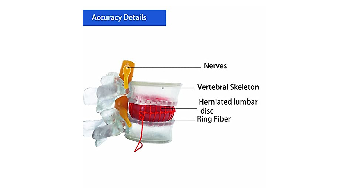Veipho Lumbar Disc Herniation Model for Education and Demonstration