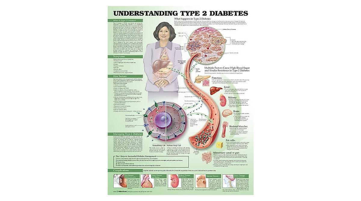 Understanding Type 2 Diabetes Anatomical Chart for Healthcare Education