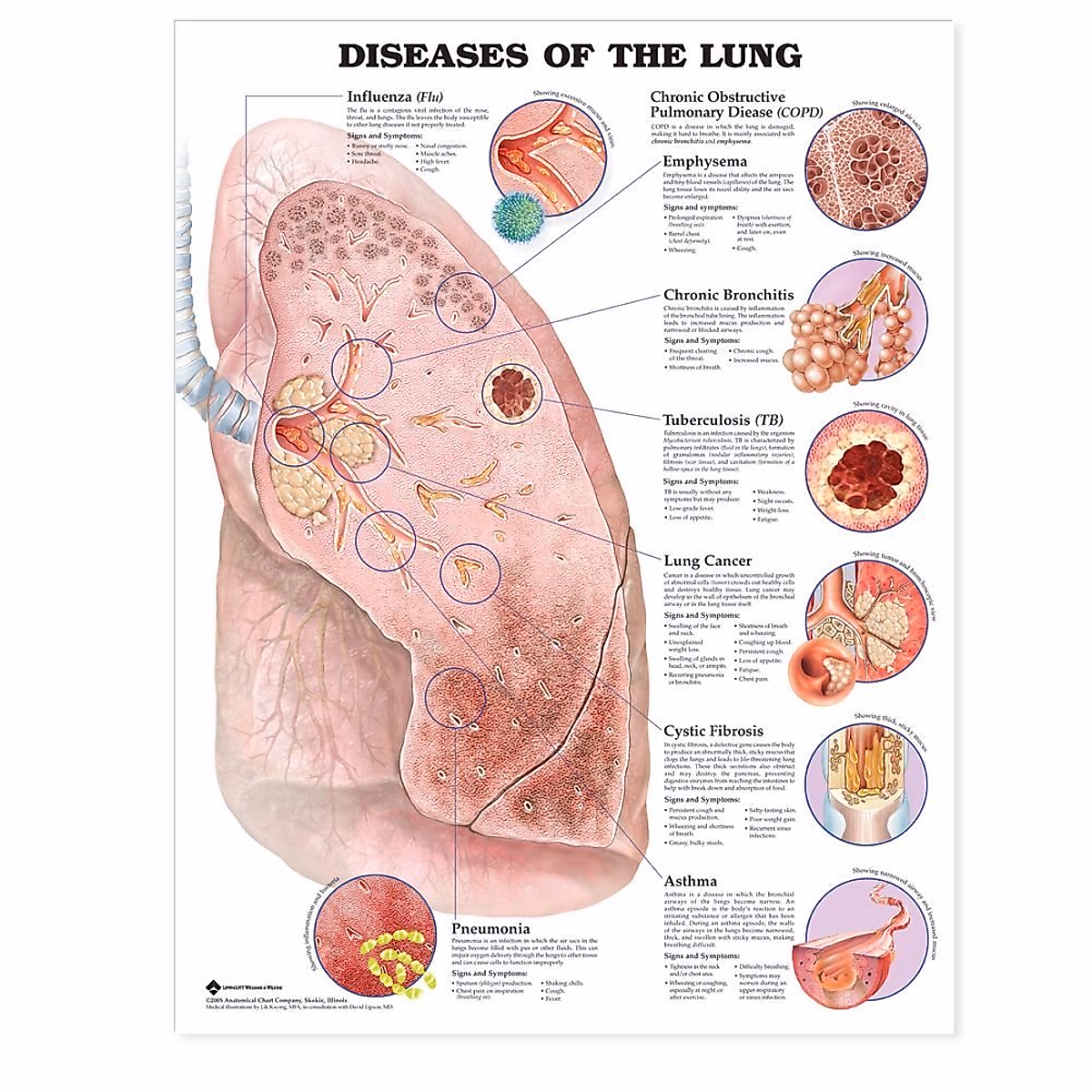 Diseases of the Lung Anatomical Chart | Medical Education Resource