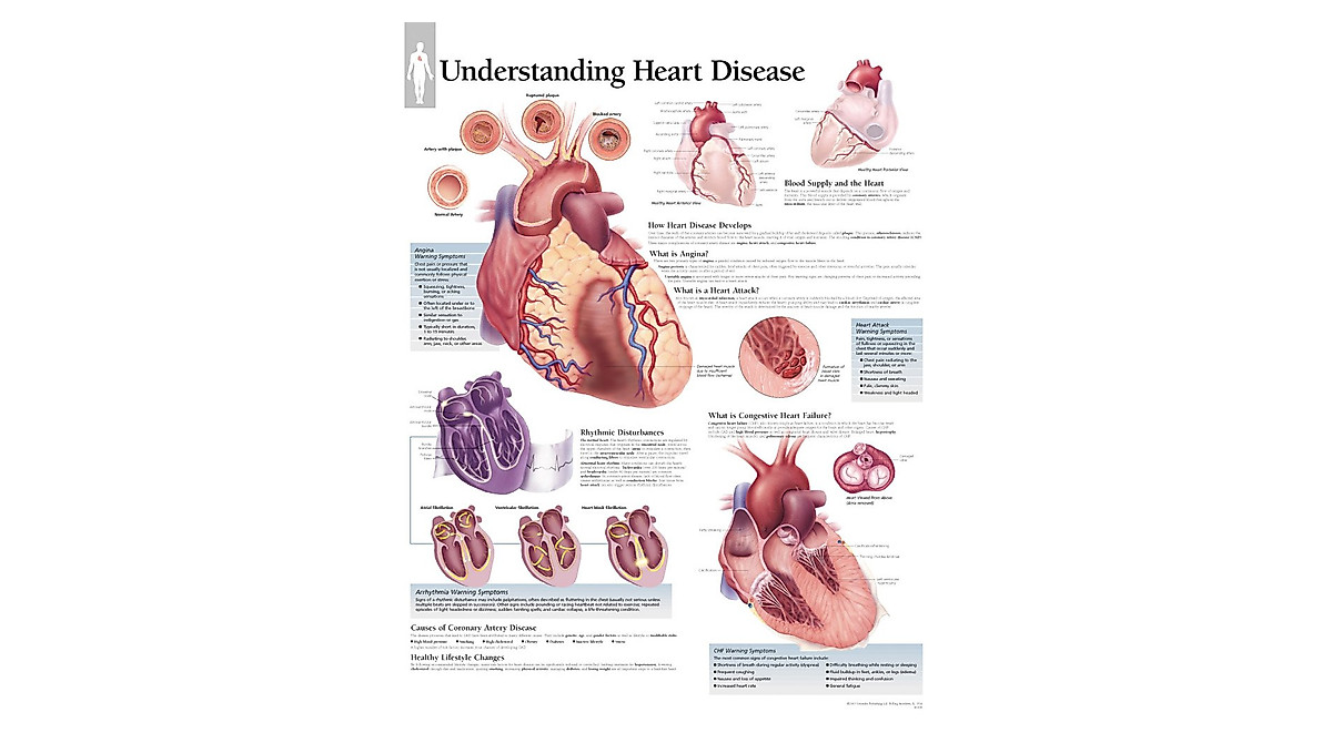 Understanding Heart Disease Wall Chart for Education