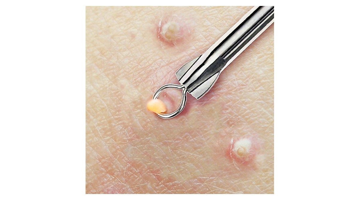 Beaute Galleria Blackhead Remover Tool - Clear Skin Now