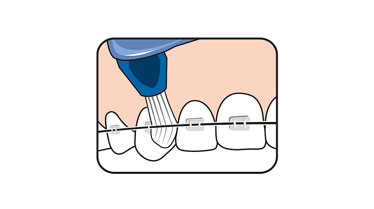 TEPE Interspace Angled Toothbrush for Braces - 12 Pack