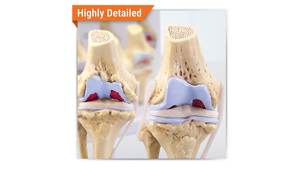 GPI Anatomicals Knee Joint Model Set - Osteoarthritis Anatomy Tools