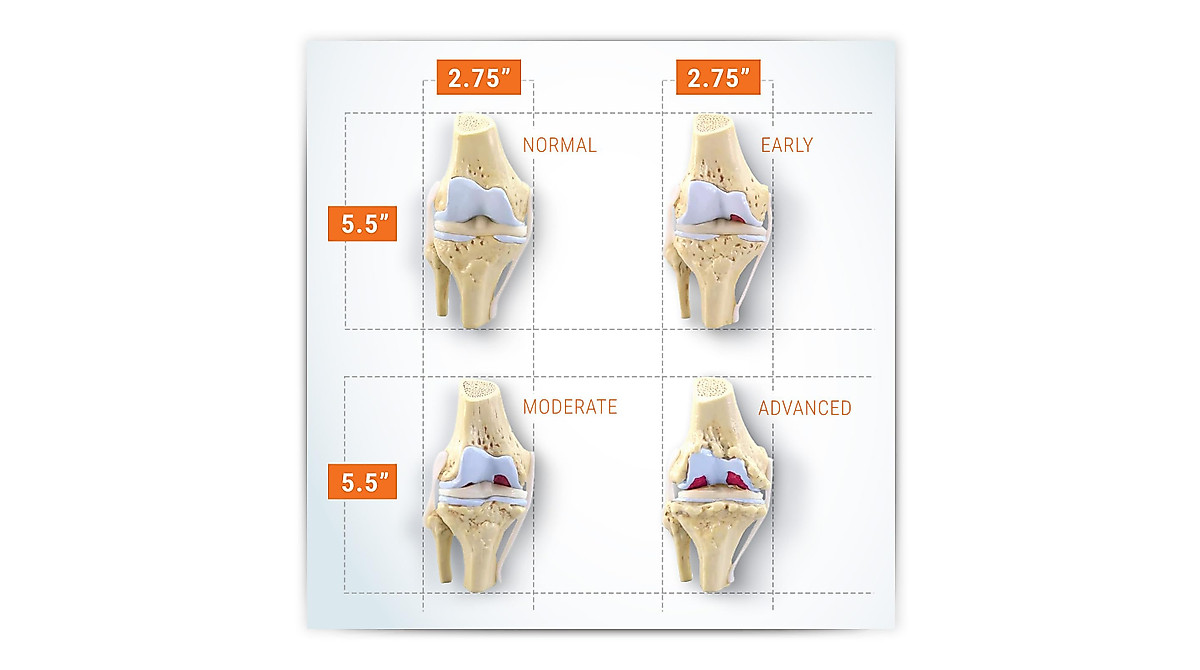 GPI Anatomicals Knee Joint Model Set - Osteoarthritis Anatomy Tools