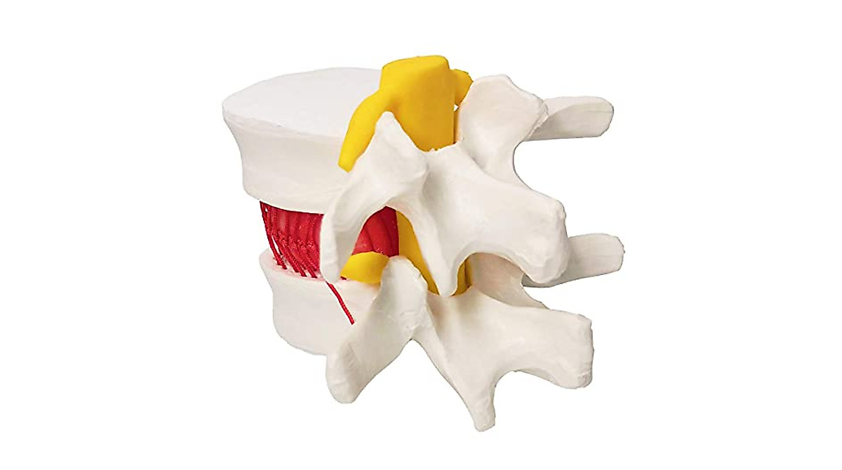 Human Herniated Disc Model for Medical & Educational Learning