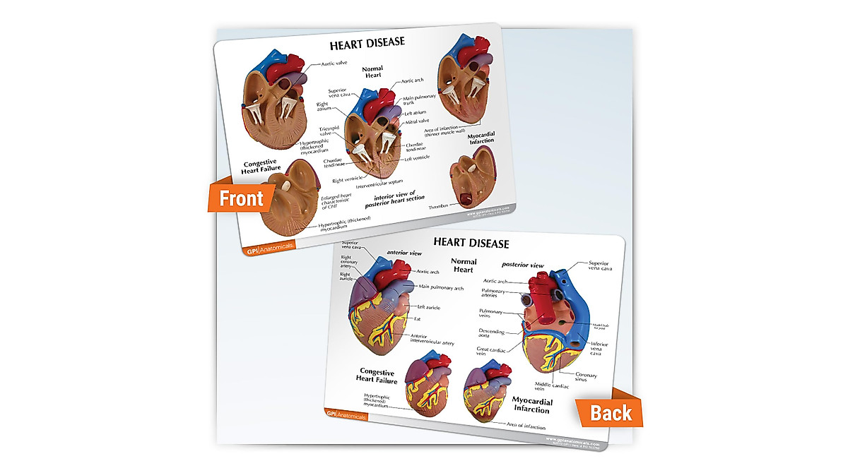 Mini Heart Model Set for Medical Education & Patient Advocacy